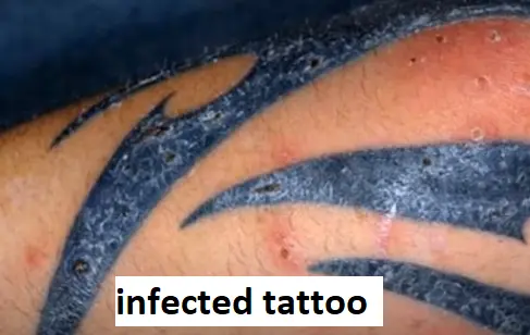 what is tattoo infection